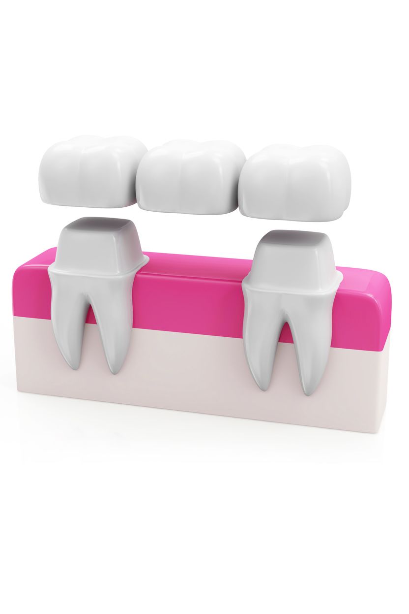 Illustration of a dental bridge