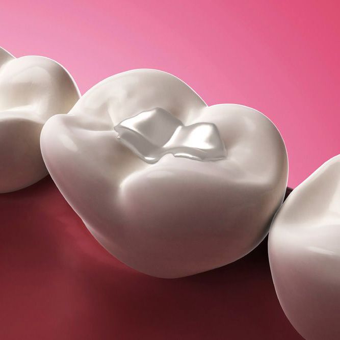 An illustration of a tooth-colored filling