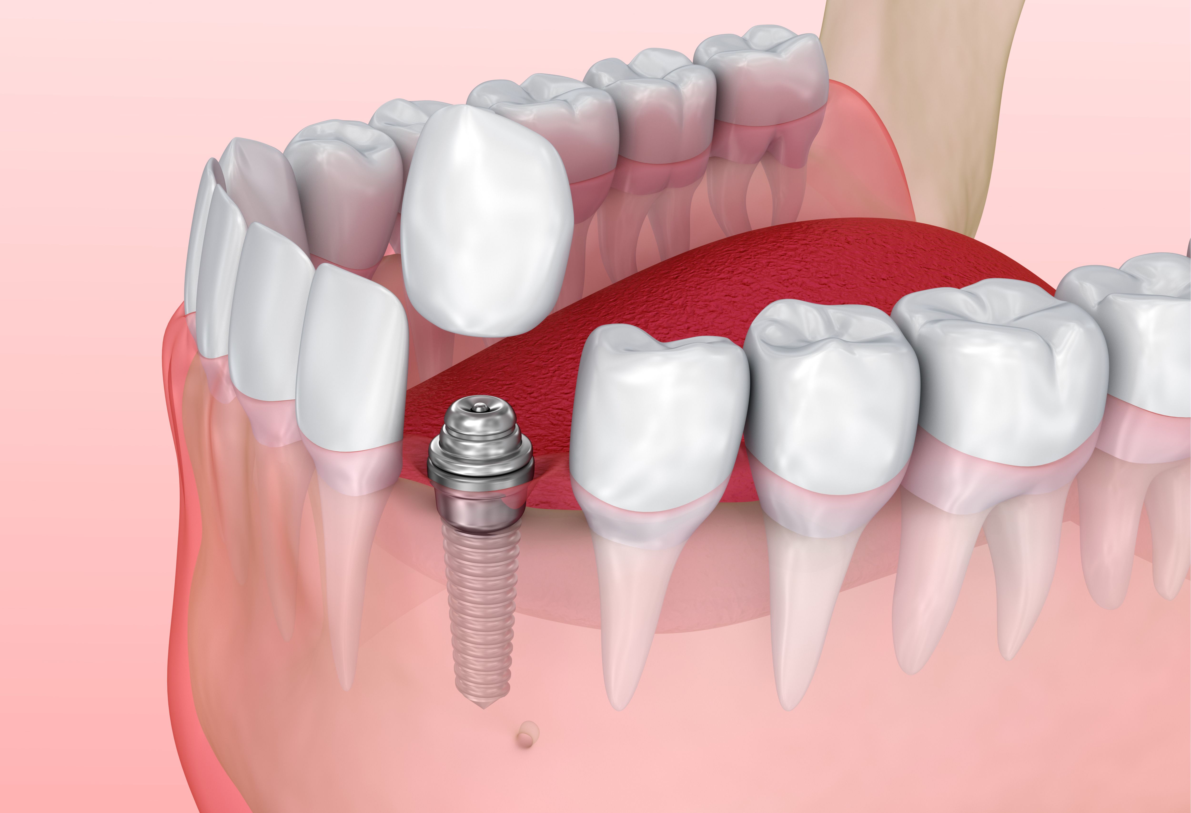 dental implants